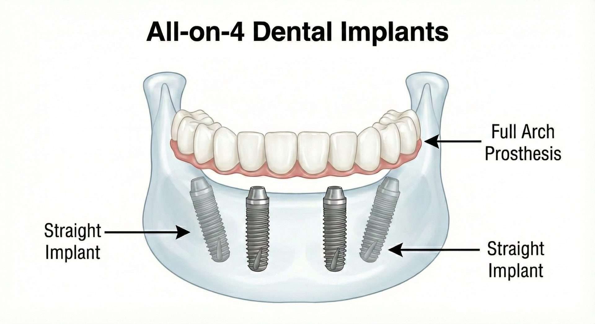All-on-4 vs All-on-6 vs Snap-On Dentures: Which Is Right for You?