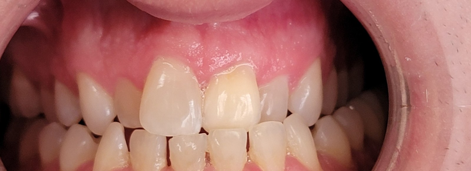 Example of a crossbite, a bite issue Invisalign can treat with arch expansion