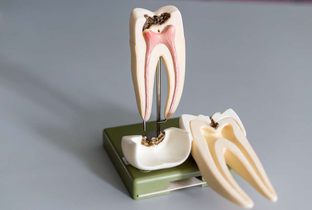 Cavities and Tooth Decay