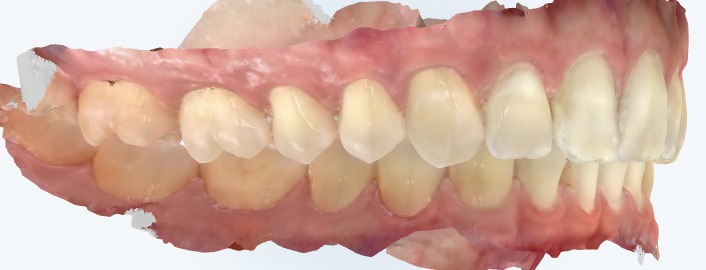 Digital scan showing a Class I bite: the upper and lower first molars line up normally, with the upper front teeth overlapping the lower front teeth just slightly