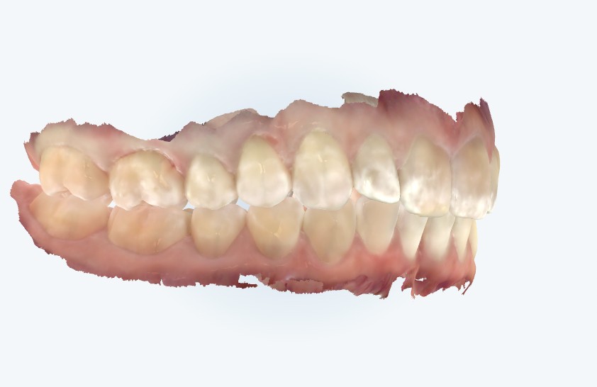 Digital scan showing a Class II bite: the lower first molar sits behind the upper first molar, and the upper front teeth are positioned ahead of the lower front teeth