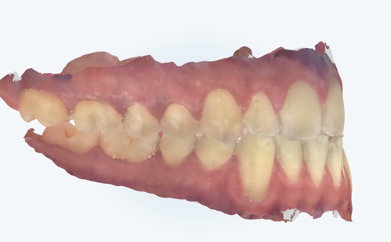 Digital scan showing a Class III bite: the lower front teeth sit ahead of the upper front teeth