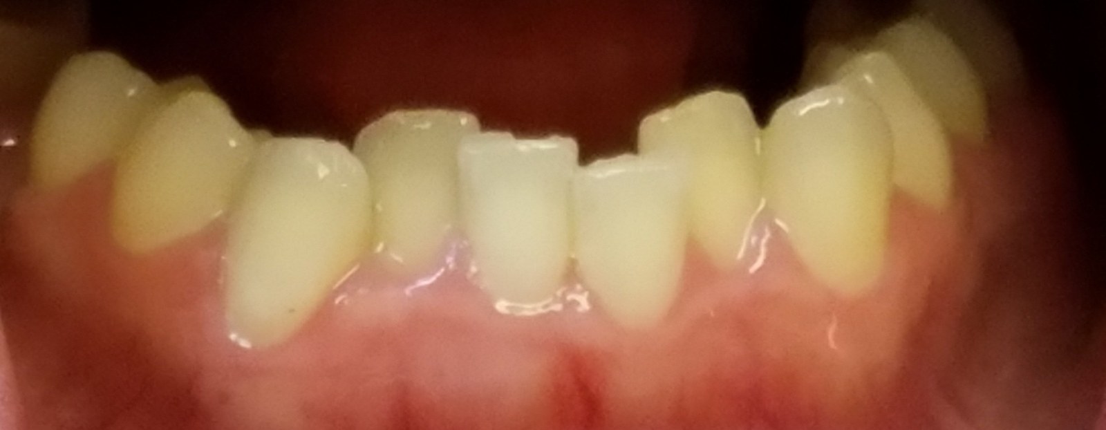 Example of dental crowding, a bite issue Invisalign commonly treats