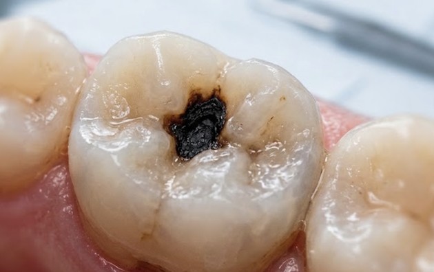 Dark Spot on a Tooth? What It Could Mean