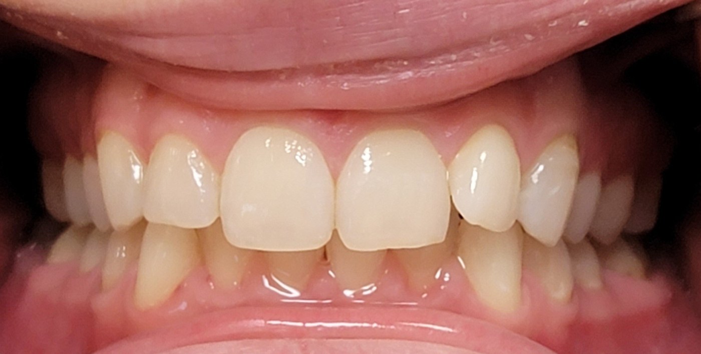 Example of a deep bite (overbite), a bite issue Invisalign can treat