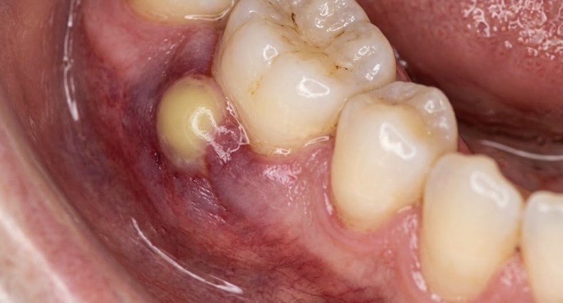 How to Recognize and Respond to a Dental Abscess