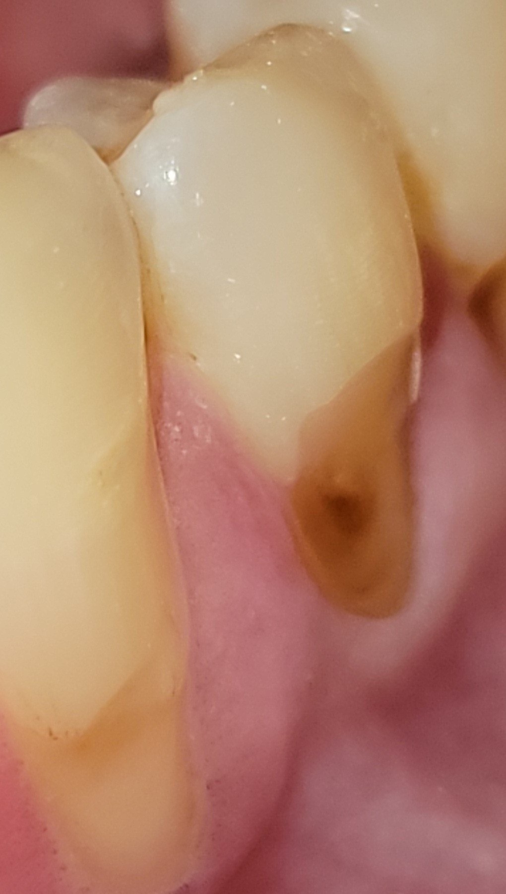 A canine tooth with visible gum recession, exposing darker, stained root surface near the gumline