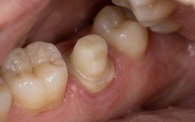 A prepared tooth with its crown missing, exposing the smaller stump underneath next to an adjacent molar