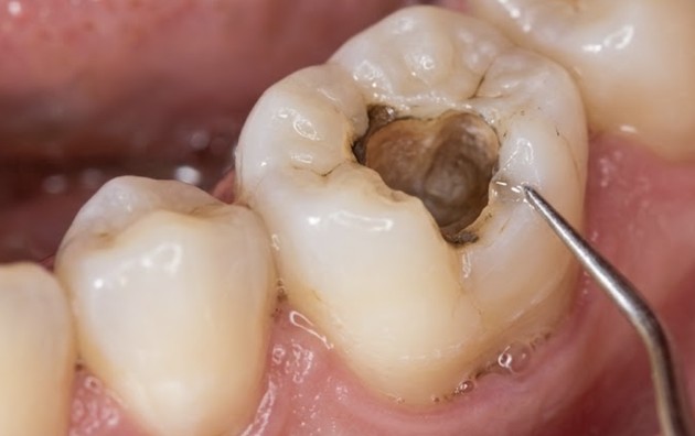 How to Handle a Lost Filling or Crown Until Your Appointment