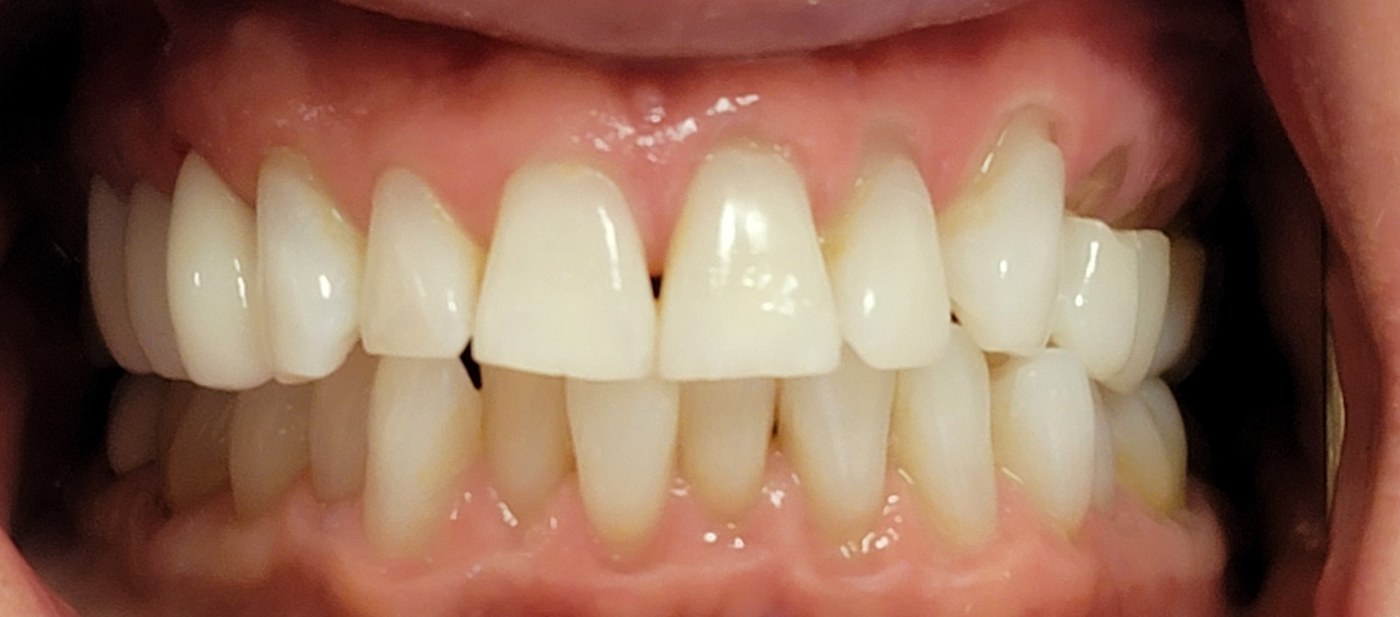 Abfraction lesions at the gumline caused by uneven flexing forces from malocclusion