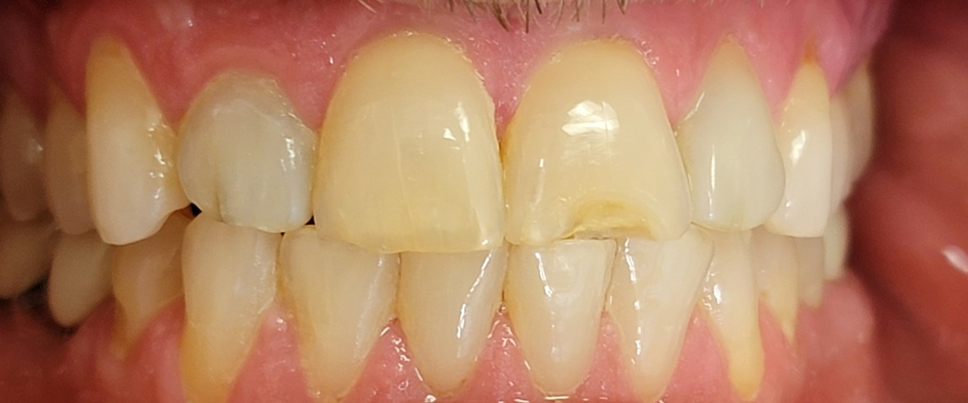 Edge-to-edge tight occlusion with no overjet or overbite, causing direct anterior tooth wear
