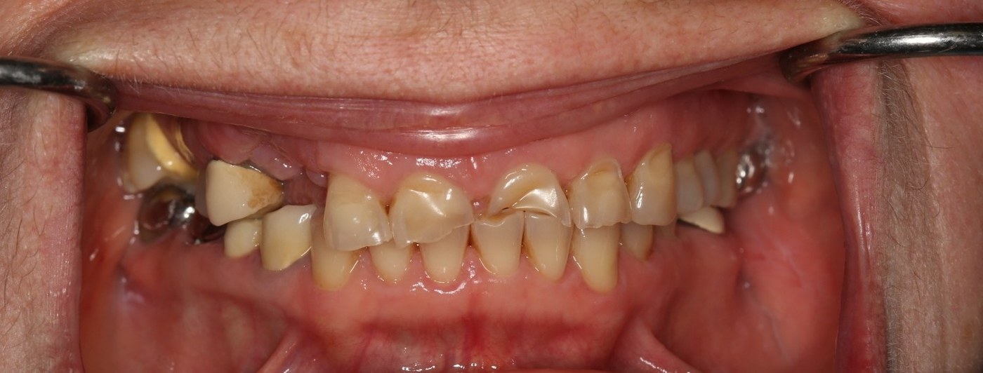 Severe generalized tooth wear and breakdown from a longstanding untreated malocclusion