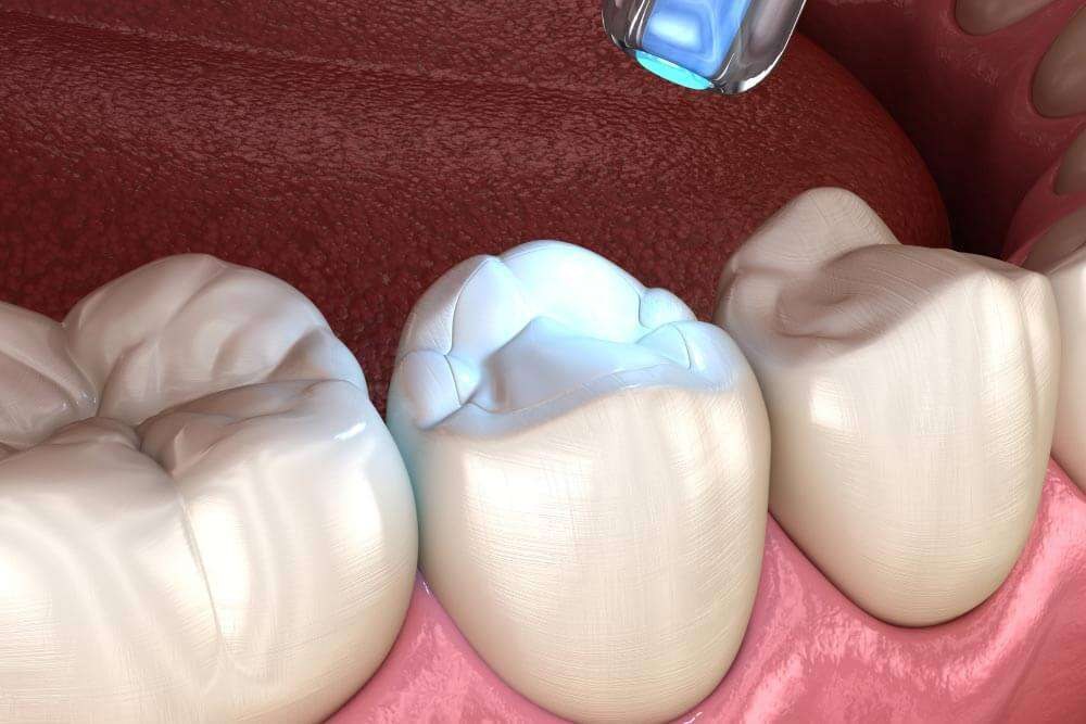 Is There Mercury in Fillings? | Mercury in Fillings Explained