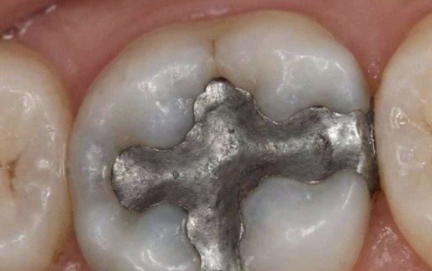 Metallic Taste in Your Mouth? Possible Dental Causes