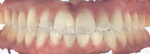 Example of a normal bite: the upper front teeth overlap the lower front teeth just slightly