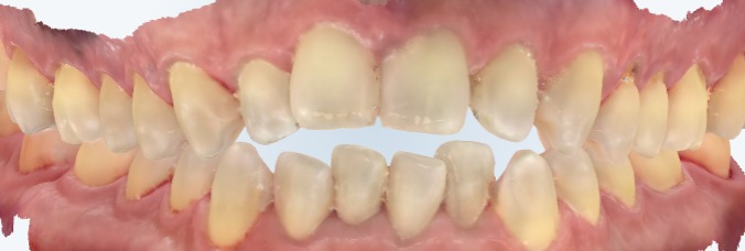 Example of an open bite, a bite issue Invisalign can treat with variable success