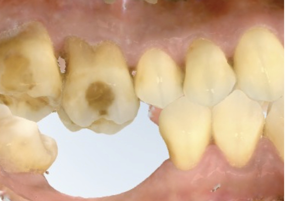 Occlusal view showing a tooth that has over-erupted into the space of a long-missing opposing tooth, with dark staining in its grooves