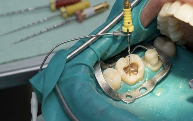 Preparing for Your Root Canal Referral: What to Expect