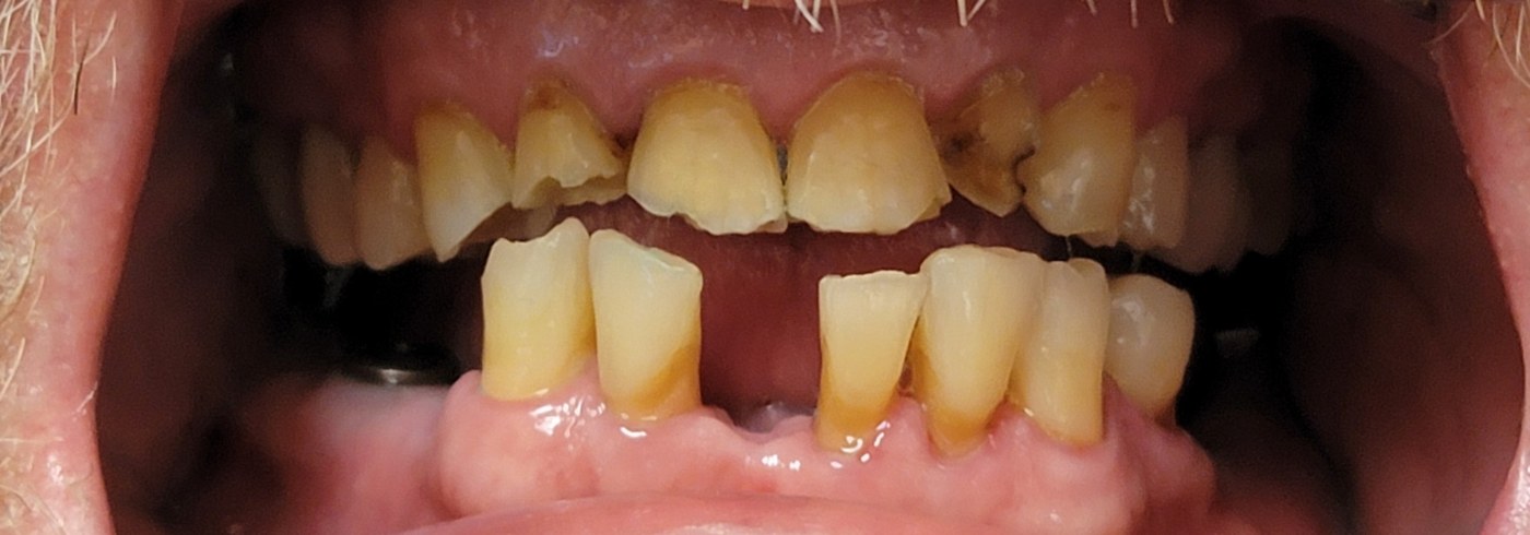 Severely worn and flattened incisal edges on the upper and lower front teeth from a severe deep bite