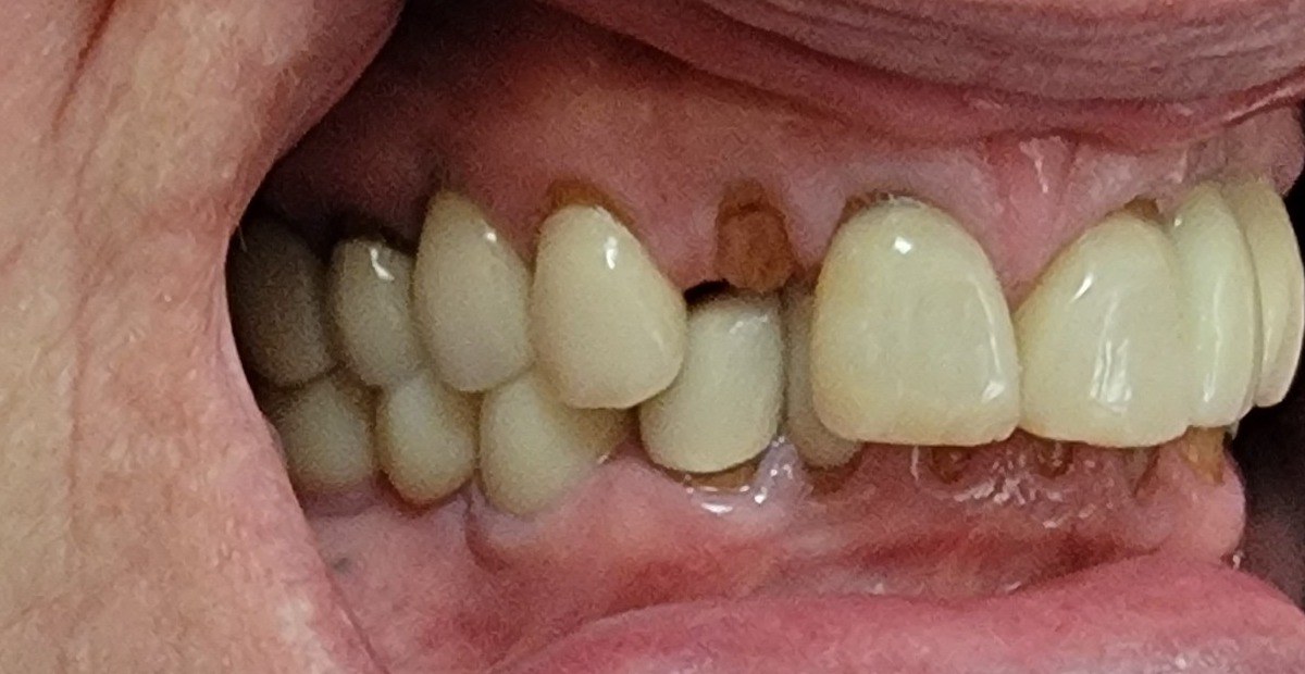 A tooth broken down to the gumline from years of abnormal contact caused by a severe deep bite