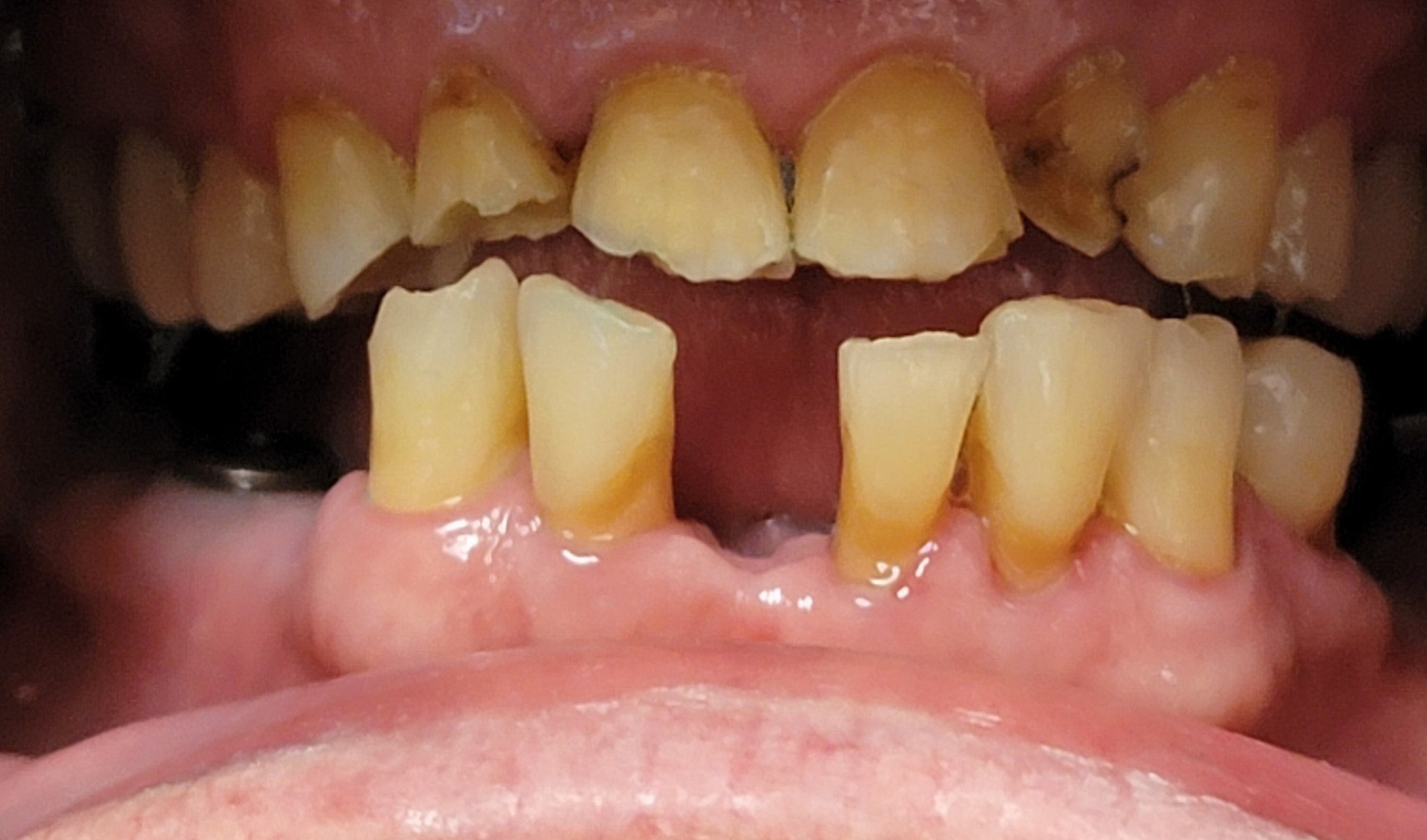 Severe occlusal wear, chipped and fractured edges, and heavy wear on both upper and lower front teeth from longstanding grinding