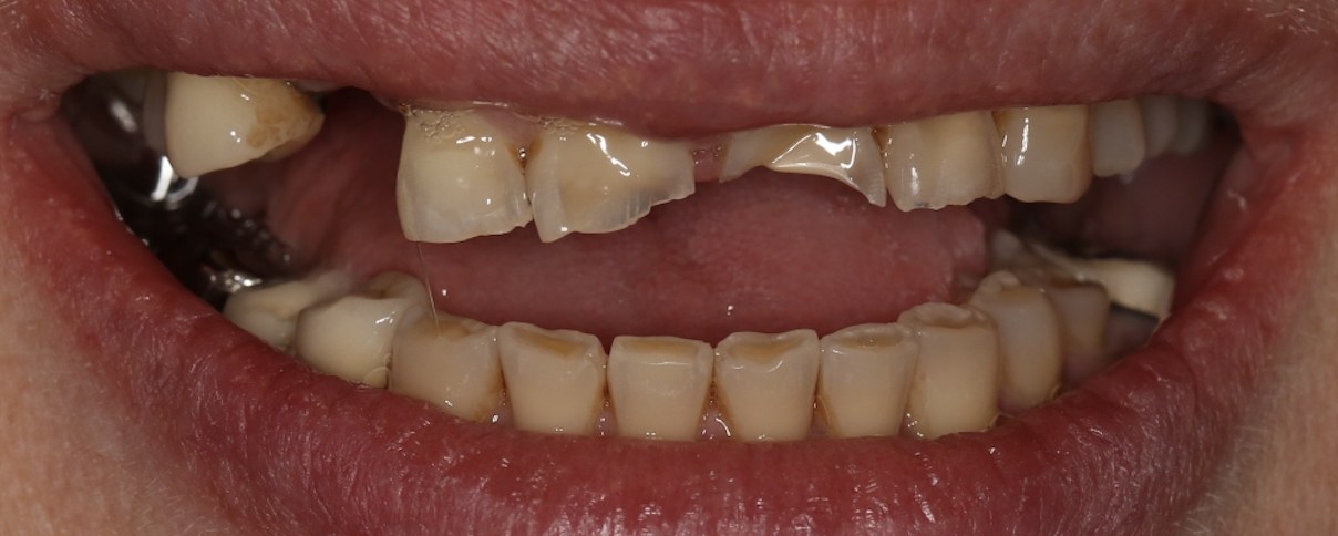 Severe occlusal wear on the back teeth and upper front teeth from longstanding, untreated teeth grinding