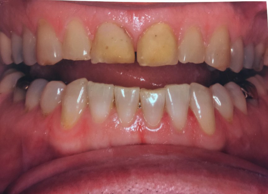 Understanding Teeth Grinding: What You Need to Know