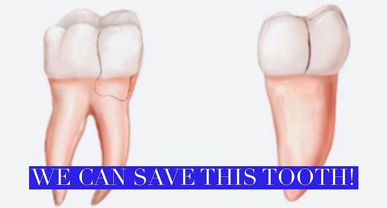 Tooth Pain When Drinking Cold Water: What's Causing It?