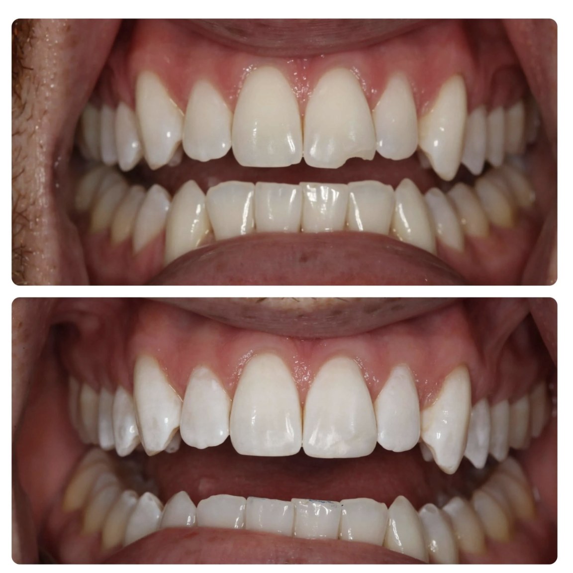 Before and after photos of a composite bonding repair at Zusin Dental