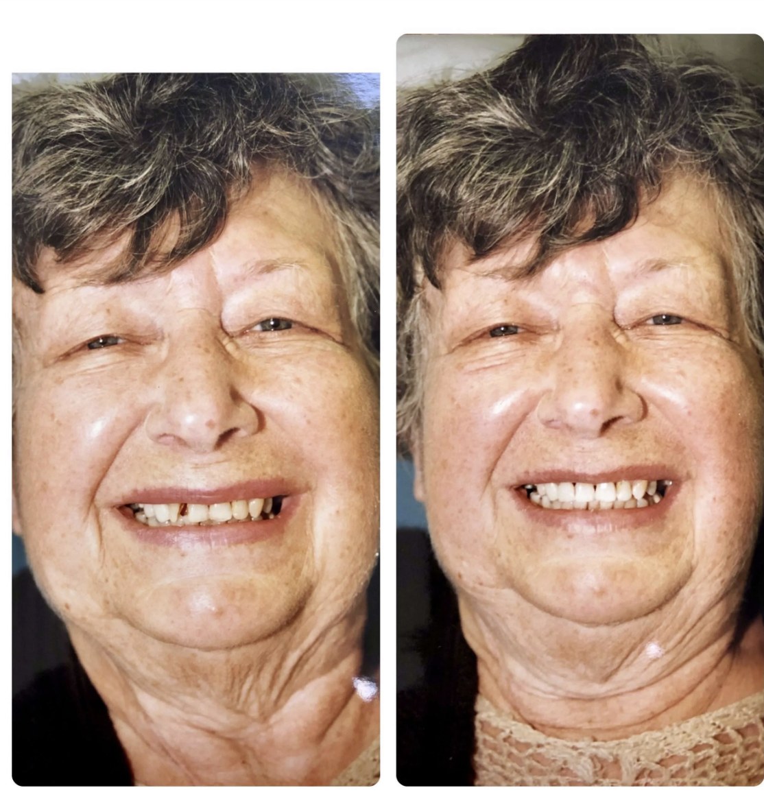 Before and after photos of a patient's smile restored at Zusin Dental
