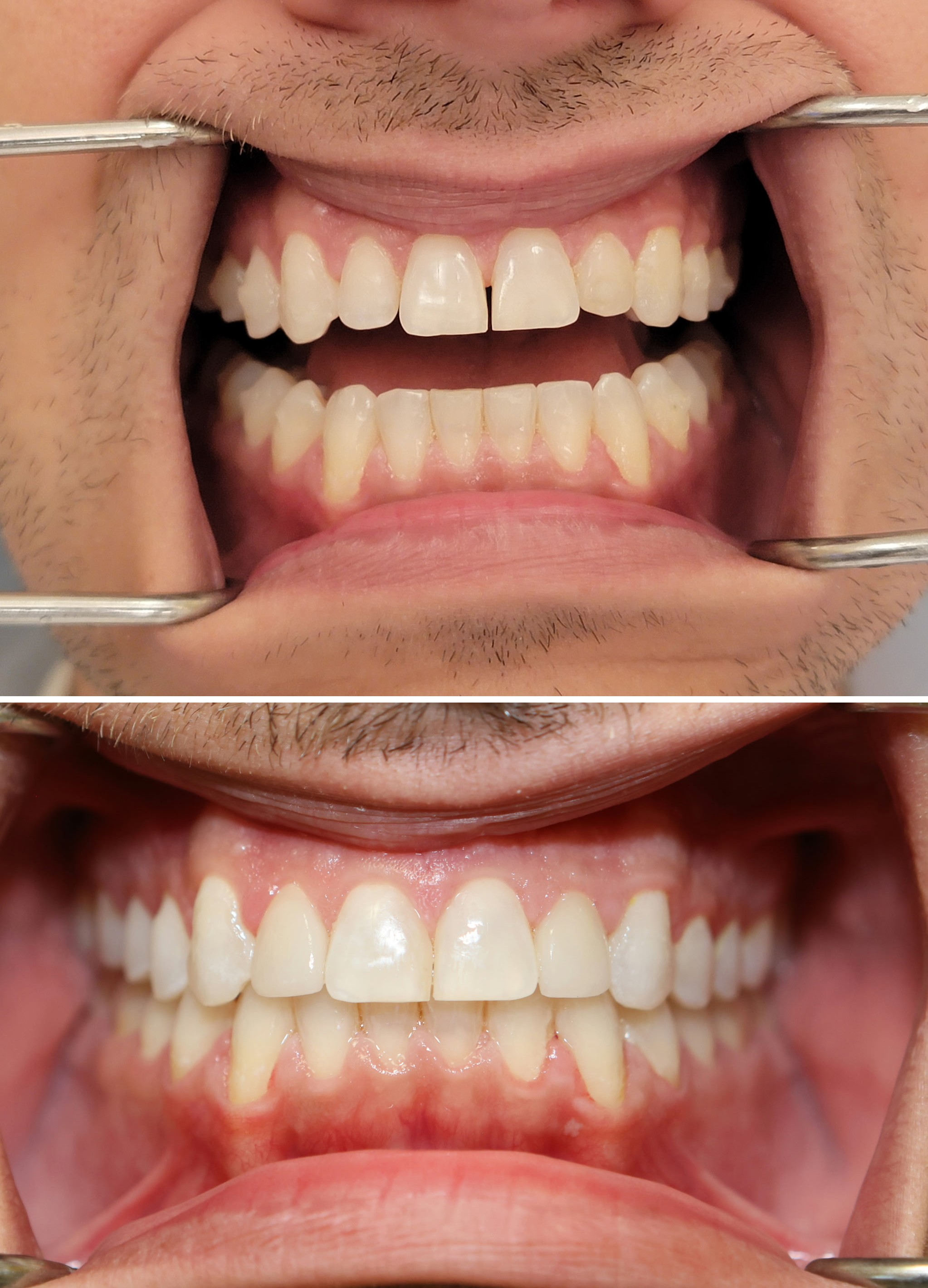 Before and after photos of a diastema closed with composite bonding at Zusin Dental