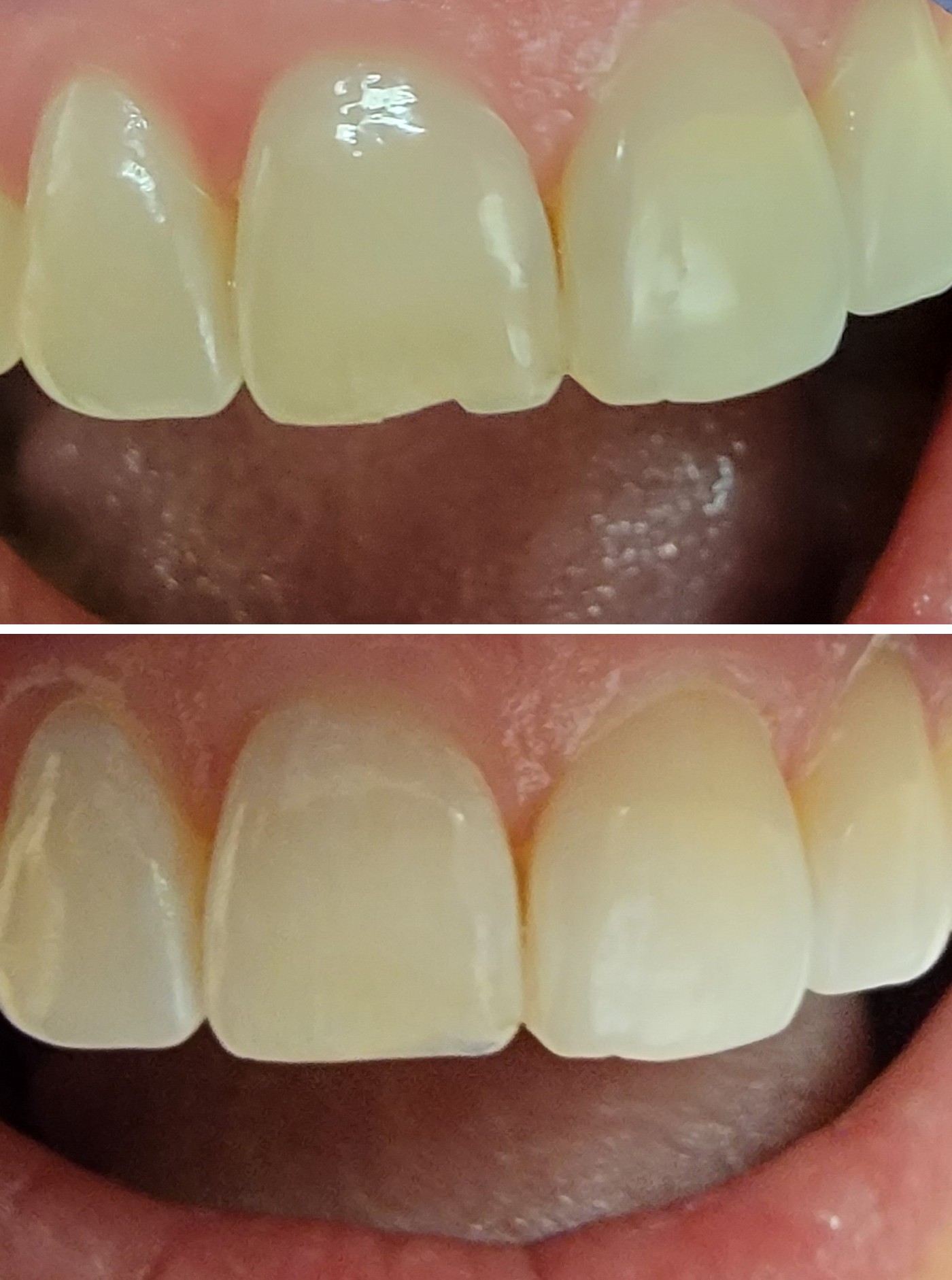 Before and after photos of a chipped front tooth repaired with composite bonding at Zusin Dental
