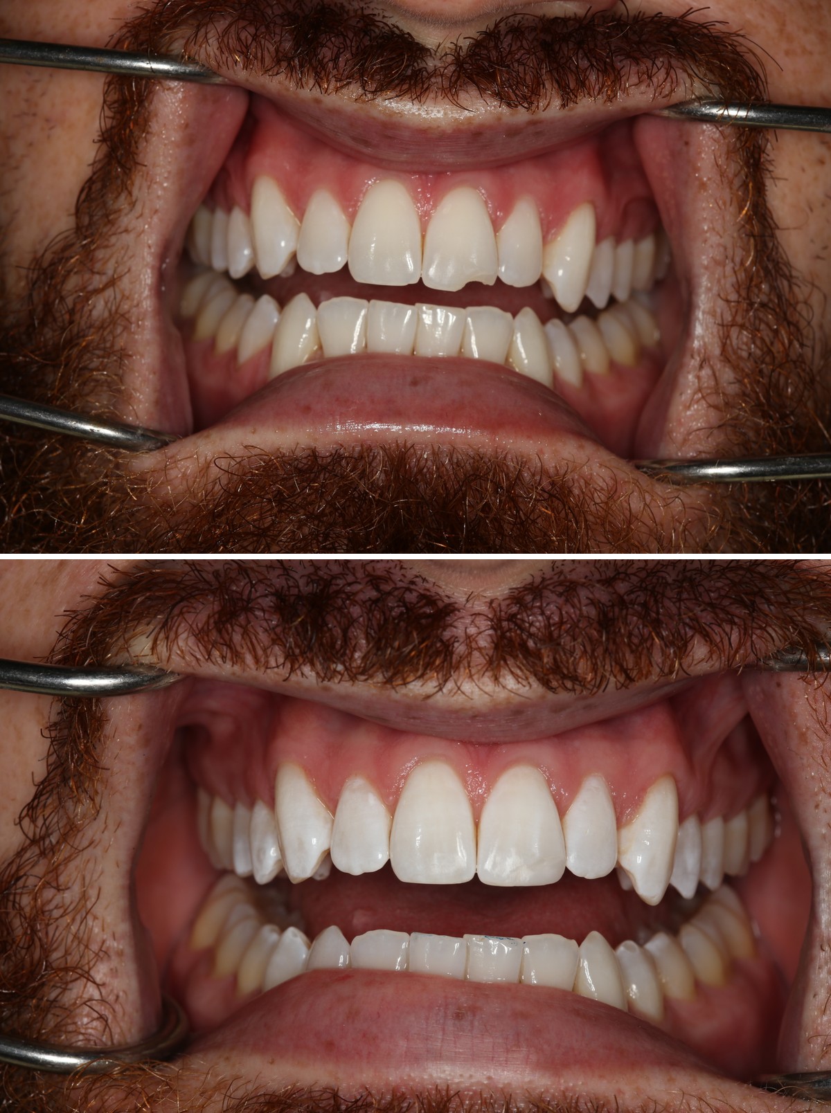 Before and after photos of a chipped upper front tooth repaired with composite bonding at Zusin Dental