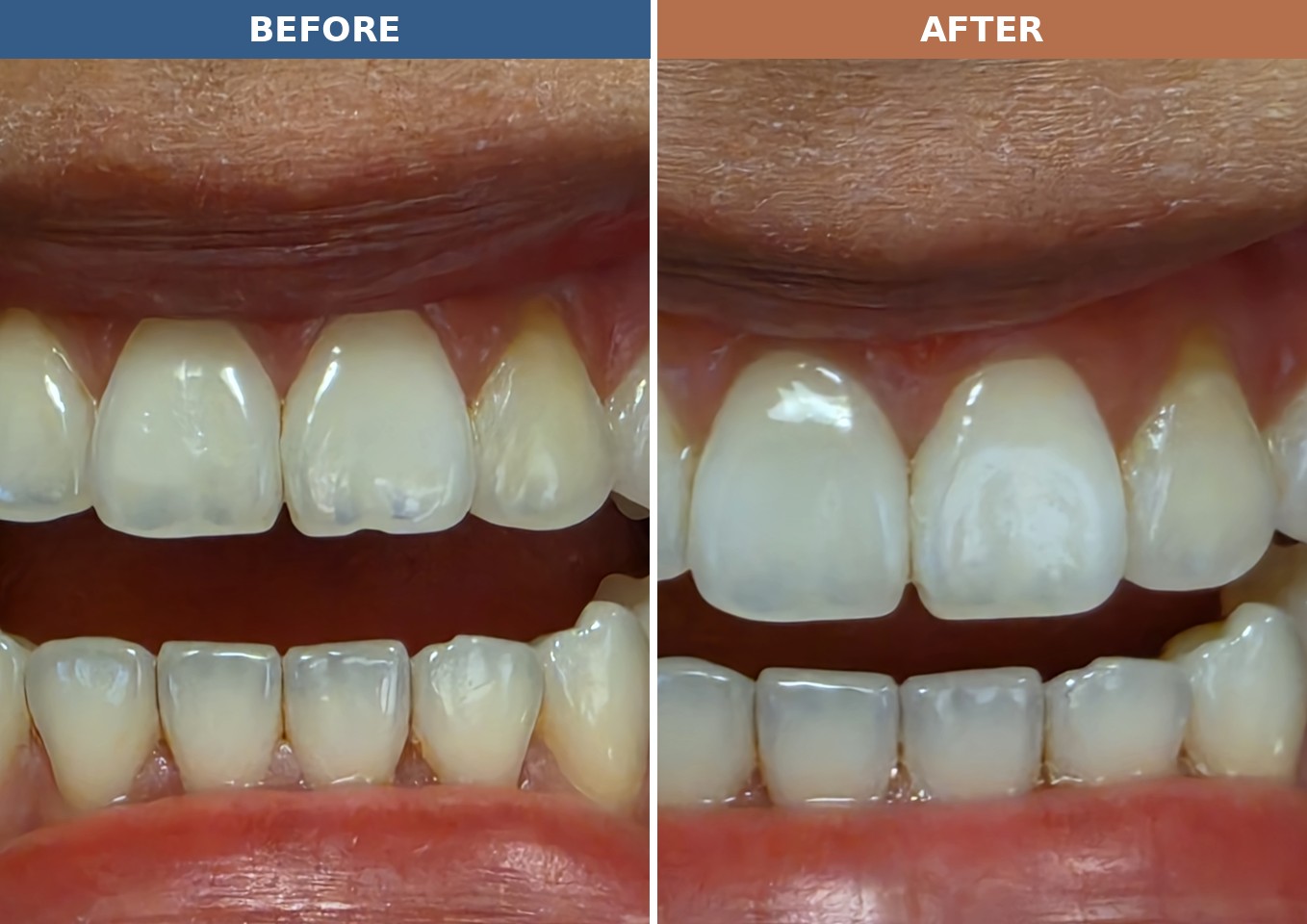 Before and after photos of a worn incisal edge restored with composite bonding at Zusin Dental
