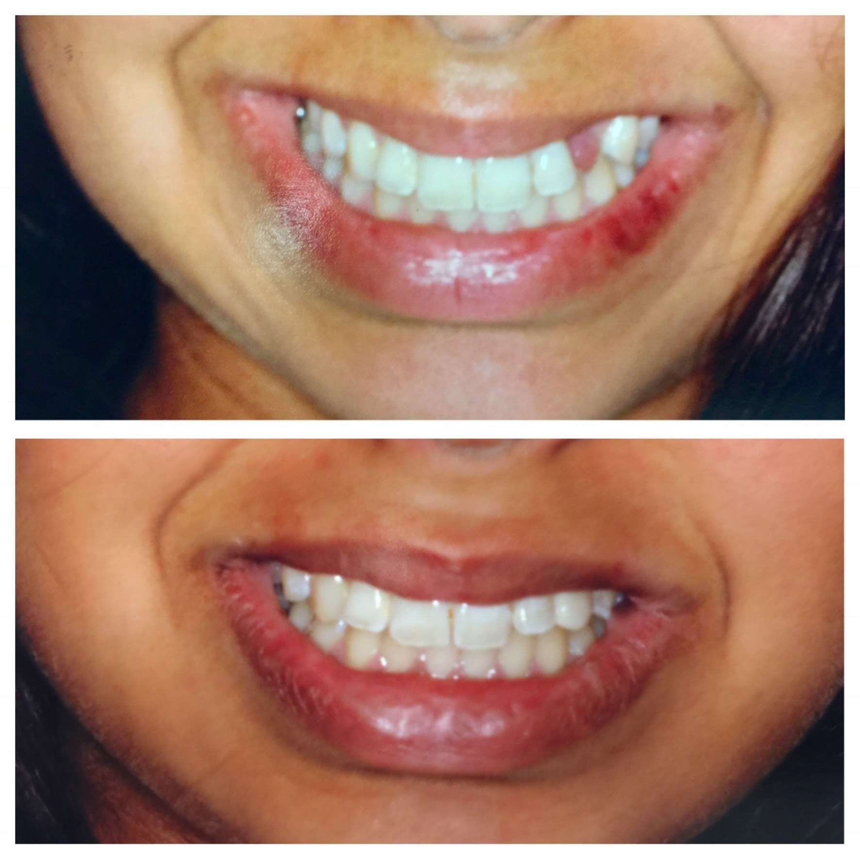 Before and after photos of a dental bridge restoring a missing tooth at Zusin Dental