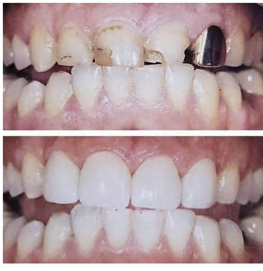 Before and after photos of a porcelain crown restoration at Zusin Dental
