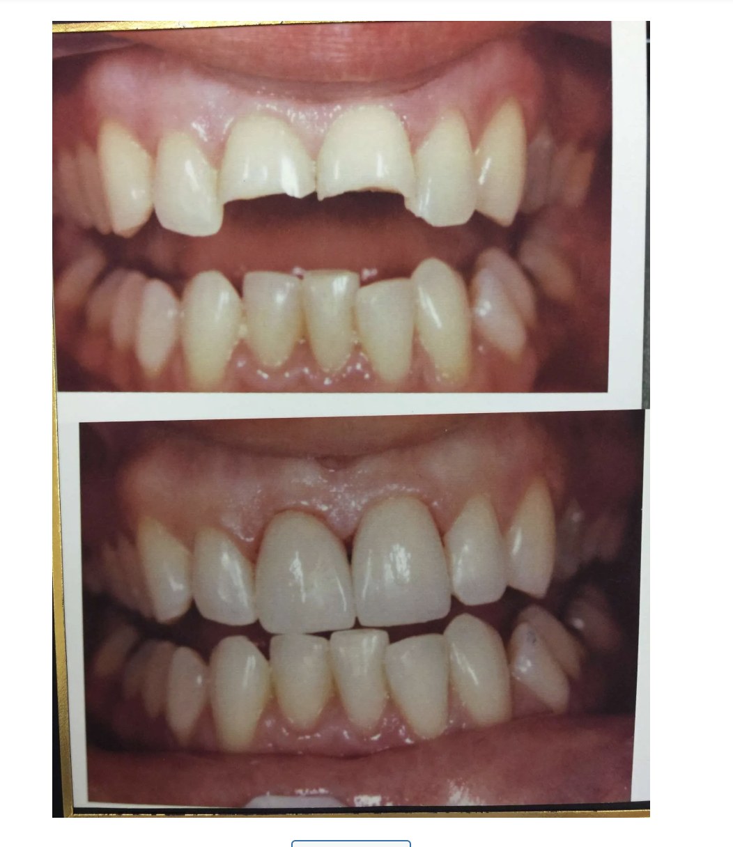 Before and after photos of a broken tooth restored with a porcelain crown at Zusin Dental