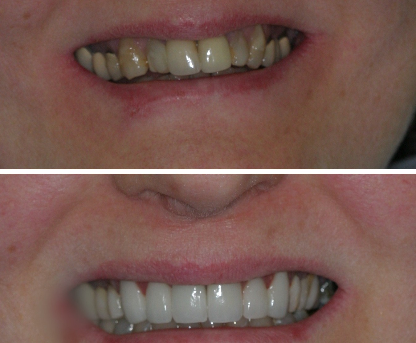 Before and after photos of a full-arch crown restoration at Zusin Dental