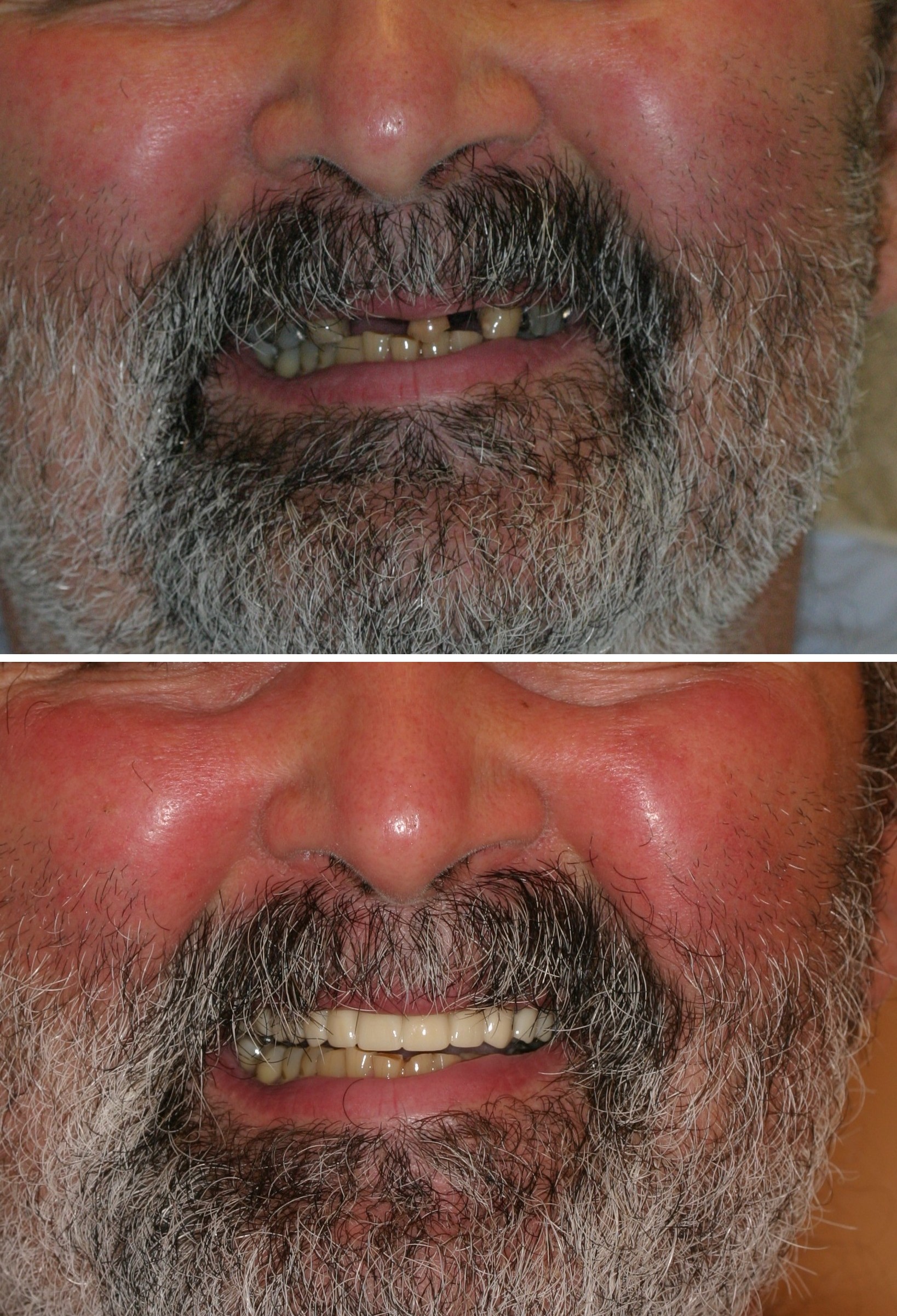 Before and after photos of a crown restoration at Zusin Dental