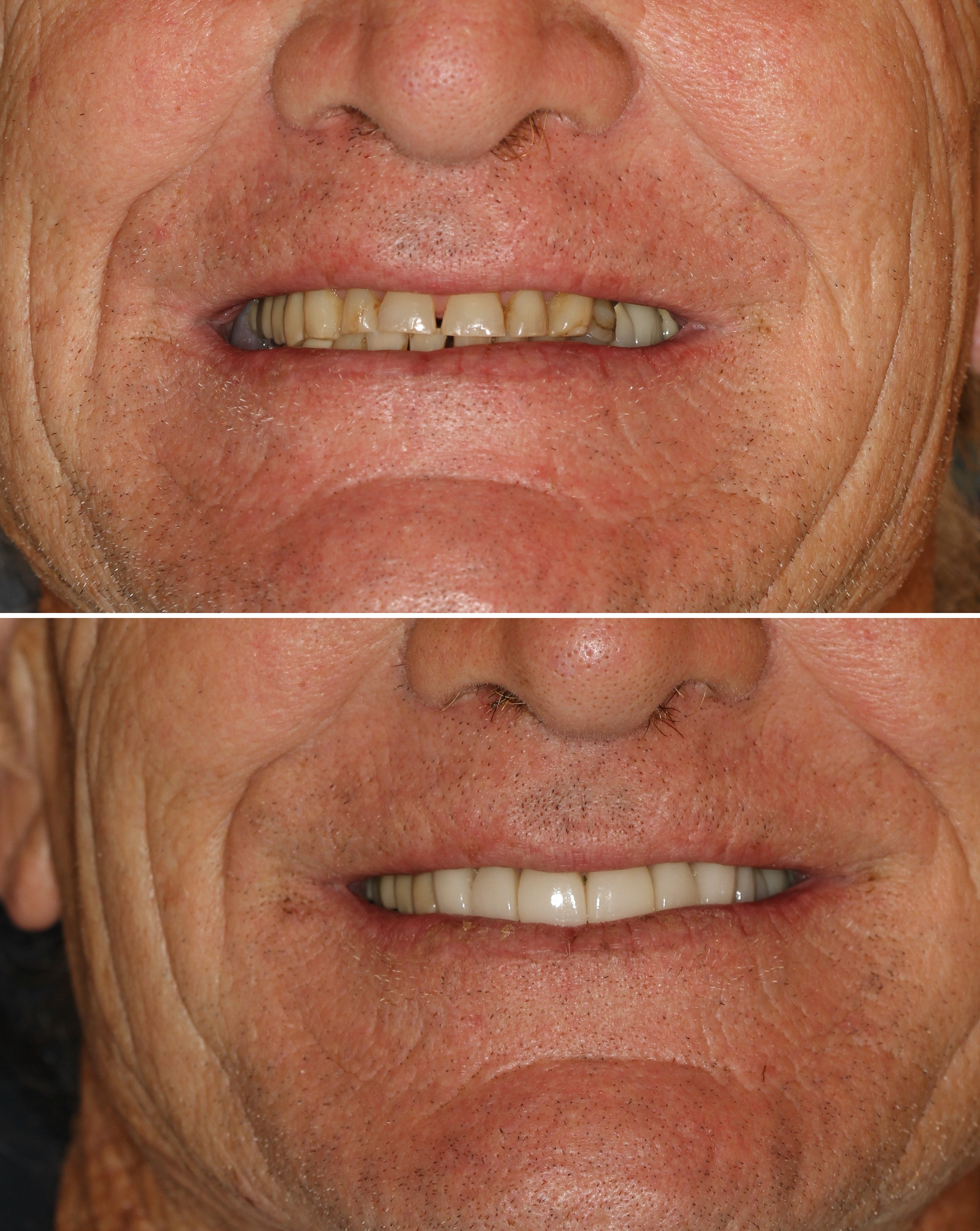Before and after photos of a full-arch crown restoration at Zusin Dental