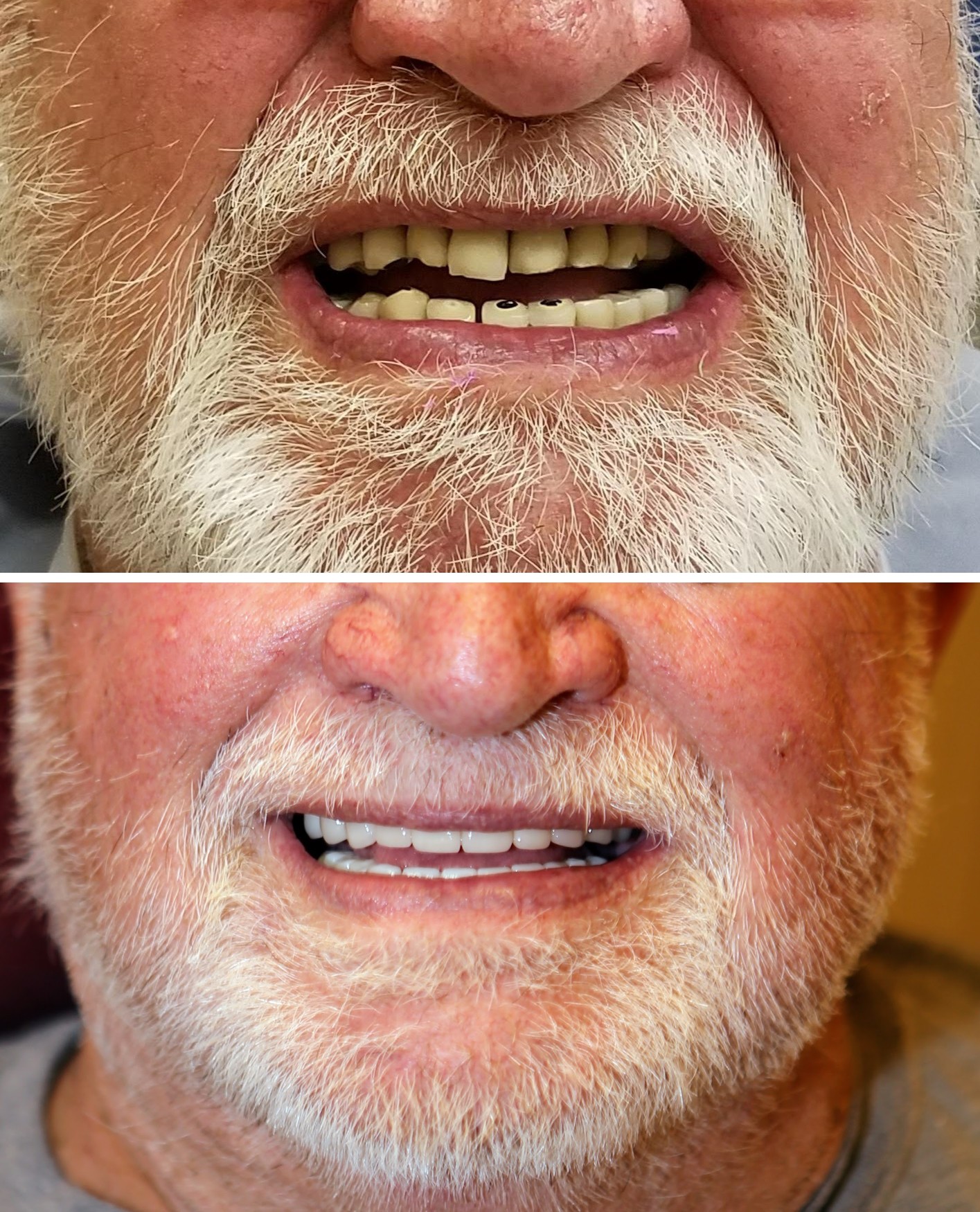 Before and after photos of broken and missing teeth restored with crowns at Zusin Dental