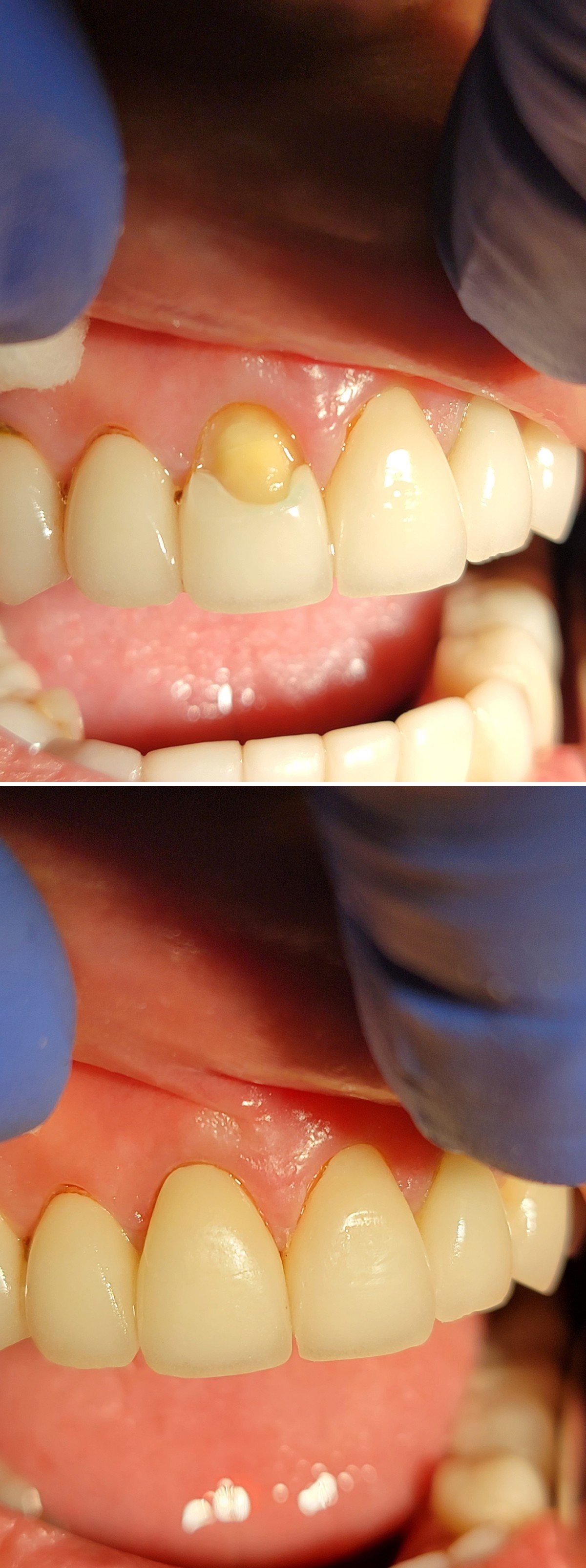 Before and after photos of a broken porcelain crown repaired at Zusin Dental