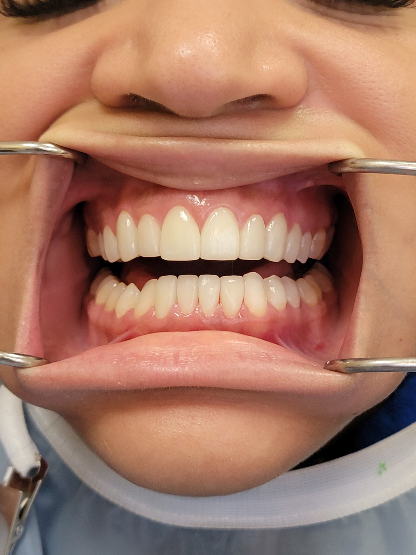 Close-up smile photo of anterior crowns at Zusin Dental