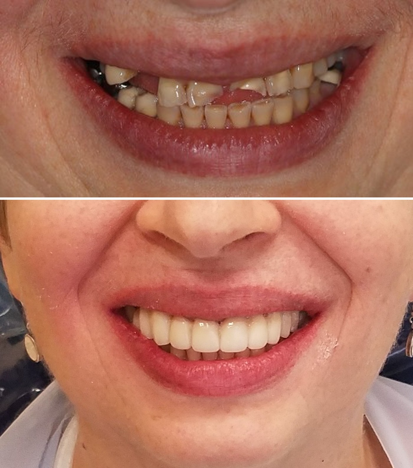 Before and after photos of provisional crowns restoring a severely worn and broken smile at Zusin Dental