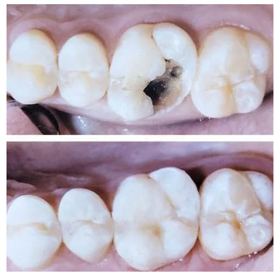 Before and after photos of a tooth-colored composite filling at Zusin Dental