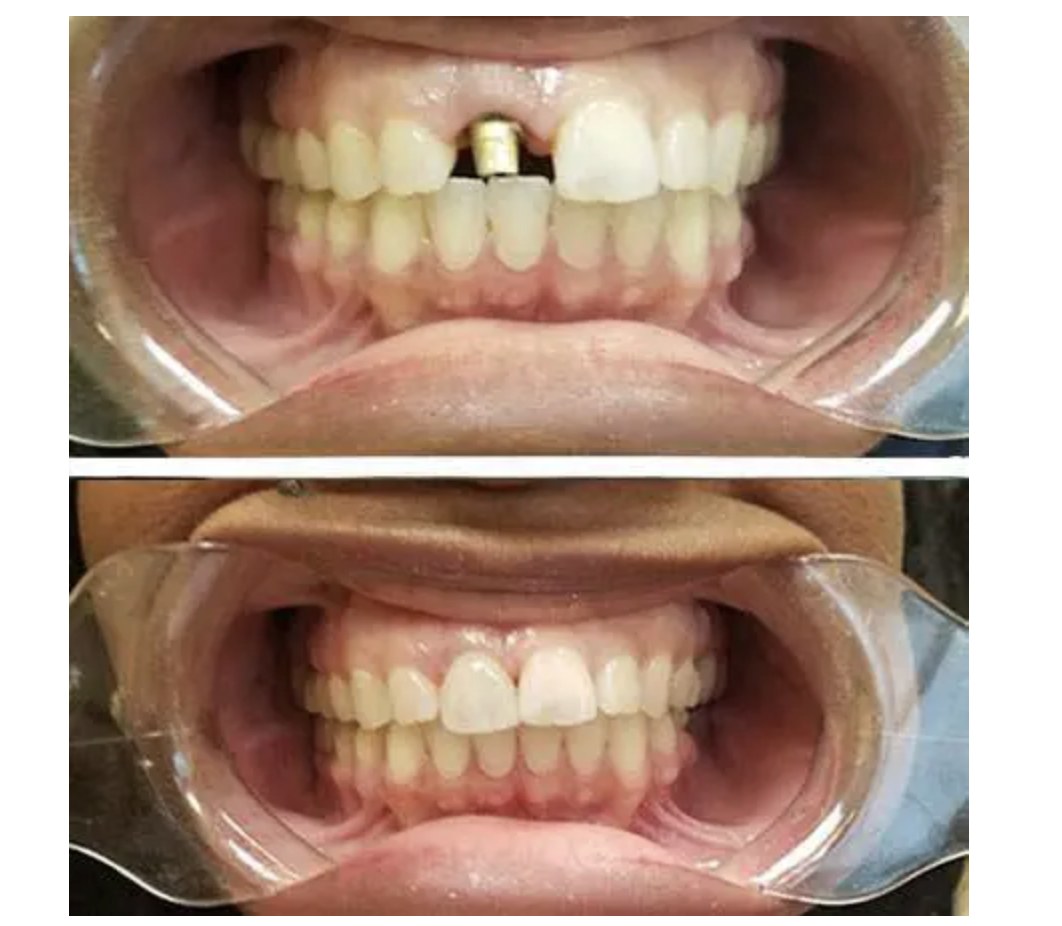 Before and after photos of a single dental implant restoration at Zusin Dental