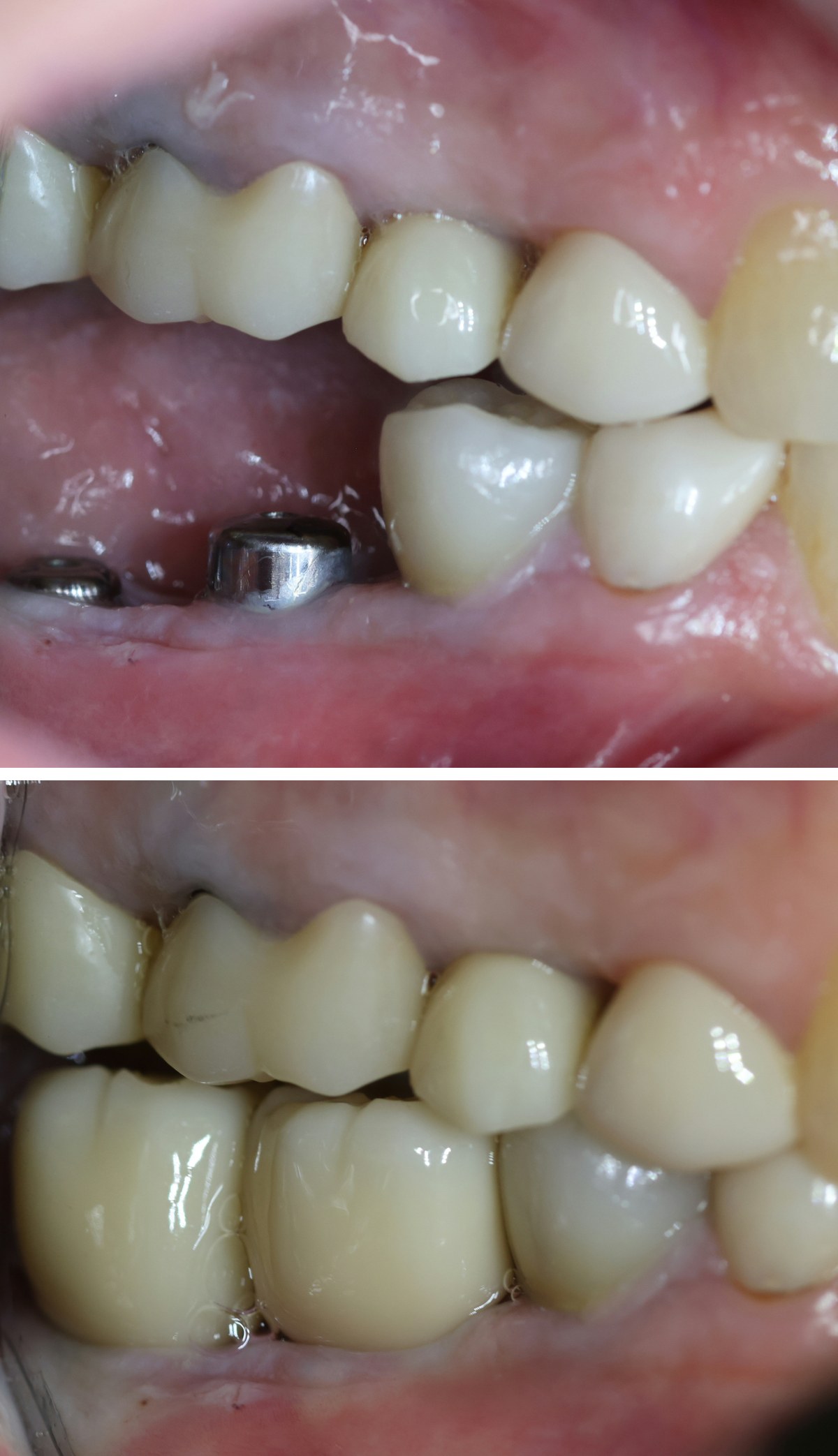 Before and after photos of two dental implants restoring lower molars at Zusin Dental