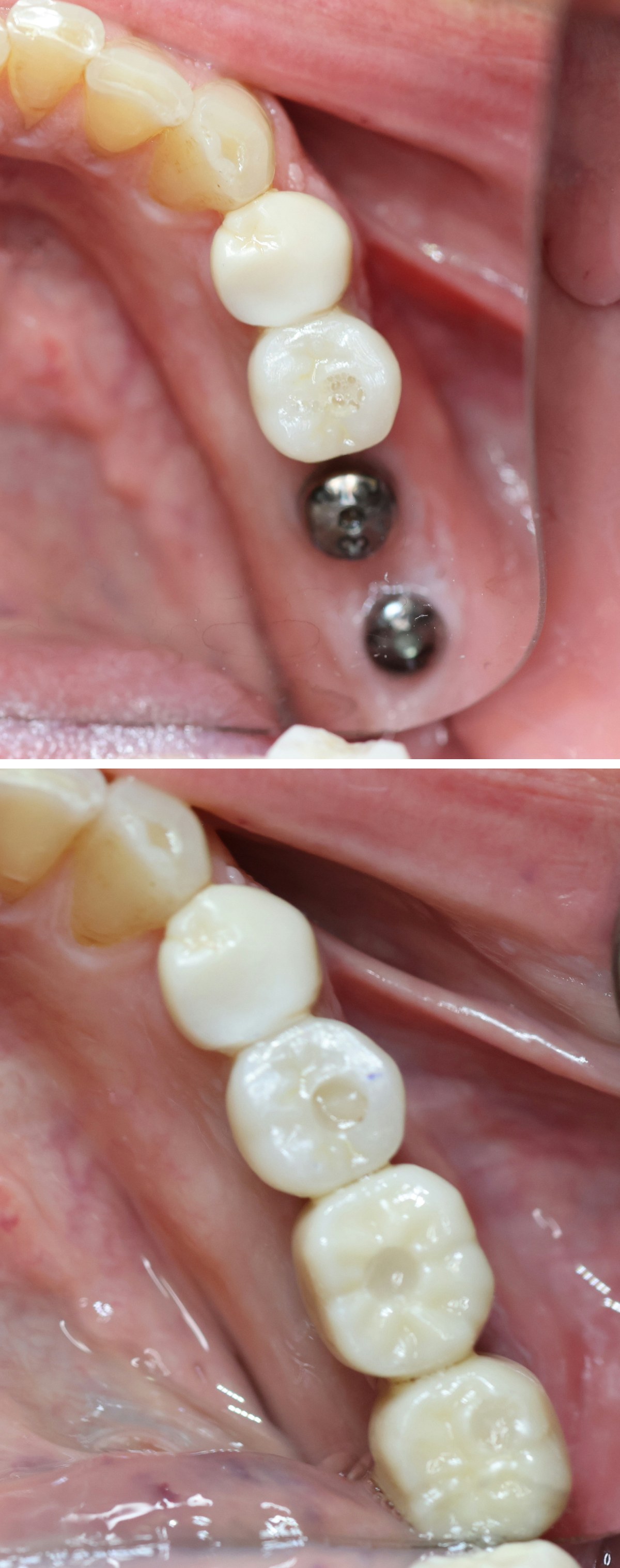 Close-up before and after photos of two dental implant crowns at Zusin Dental