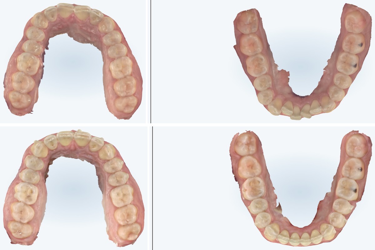 Before and after digital scans of a real Zusin Dental patient's lower arch, showing crowding resolved and a more rounded arch form with Invisalign