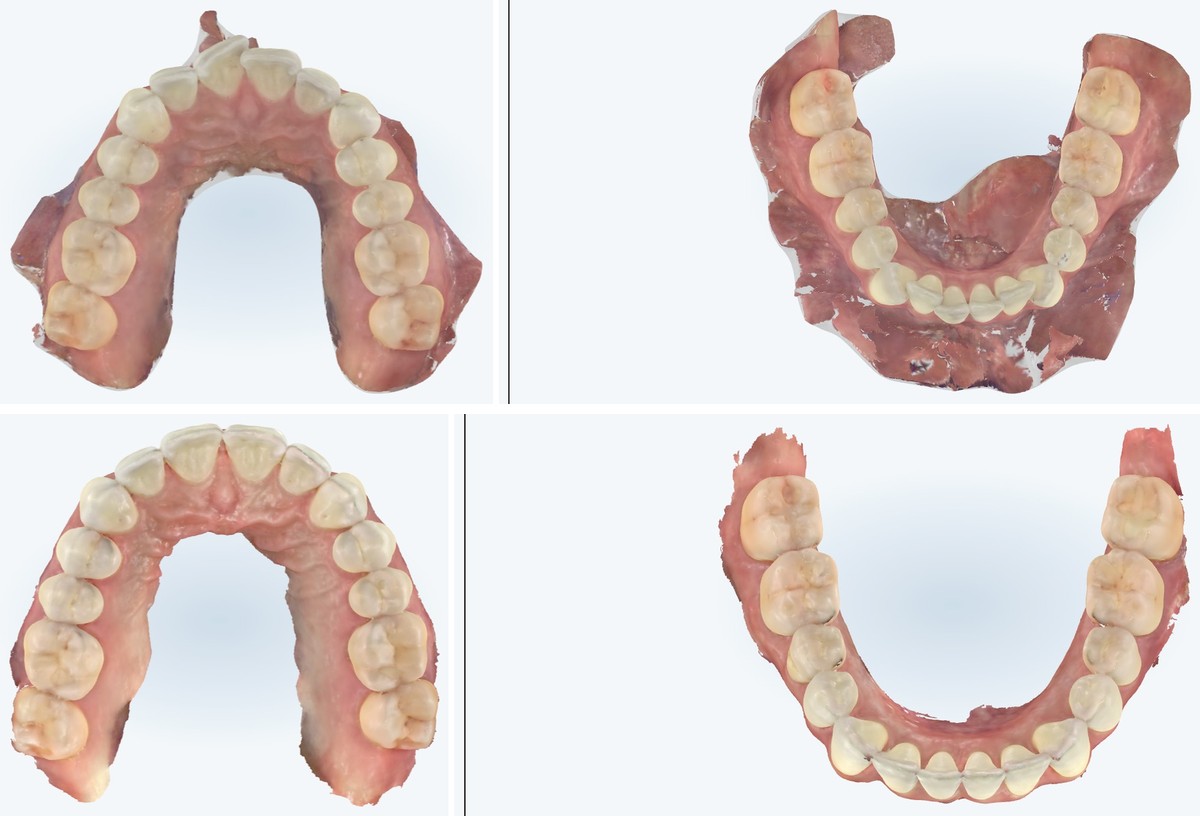 Before and after digital scans of a second real Zusin Dental patient's arches, showing crowding resolved with Invisalign